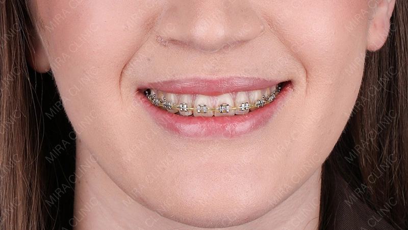  aligners (dental braces).